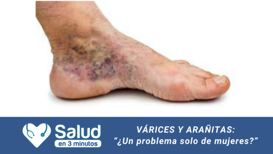 VÁRICES EN LOS HOMBRES: Un problema que no es exclusivo de las mujeres