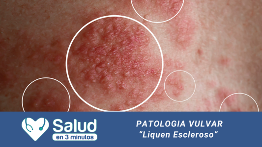 PATOLOGÍAS VULVARES: Liquen Escleroso