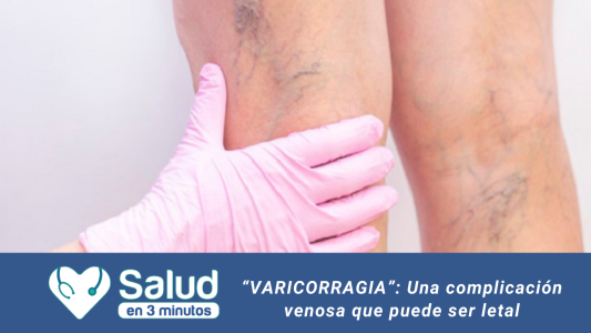 “VARICORRAGIA”: La mayor complejidad de las várices