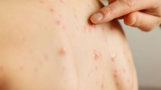 Confirman otro caso de sarampión en la Ciudad de Buenos Aires: ya suman tres en el país