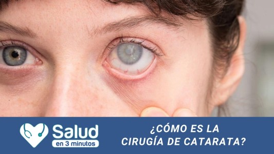 La medicina ocular avanza para extraer cataratas: te contamos los avances tecnológicos aplicados en su cirugía