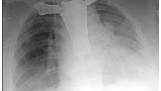 Hospital de Córdoba Realiza Histórica Cirugía con Prótesis de Impresión 3D