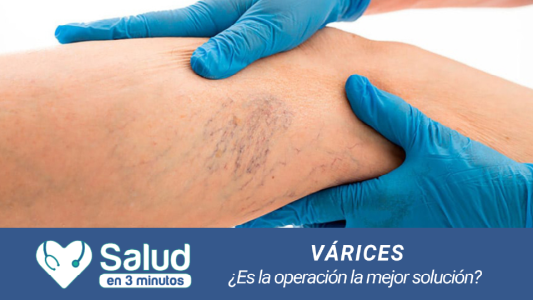 Várices: ¿Operación sí u operación no?