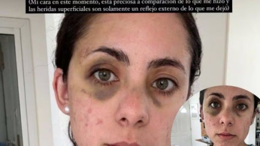 Un fisicoculturista golpeó brutalmente a su pareja en Alta Gracia
