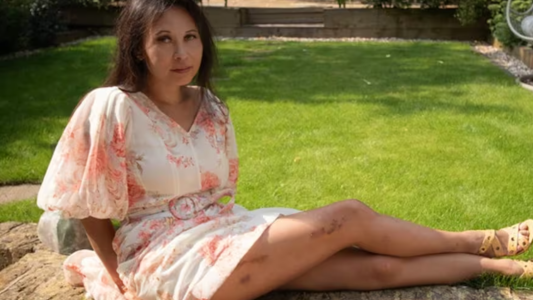 La pesadilla de una mujer que se sometió a una procedimiento para alargarse las piernas