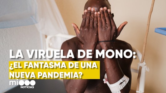 Viruela del mono: ¿El fantasma de un nueva pandemia?