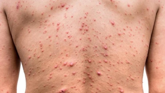 Detectaron siete nuevos casos de viruela del mono en Argentina