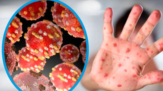 Reportaron 11 nuevos casos de la viruela del mono: siete en la Ciudad de Buenos Aires y el resto en la provincia