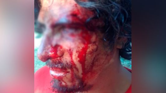 Motochorros lo molieron a golpes hasta fracturarle el ojo mientras esperaba en una parada de colectivo