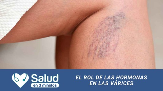 ¿Cómo es el impacto hormonal en la aparición de várices y arañitas?