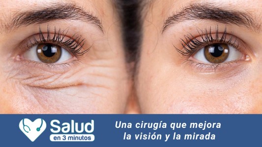 Blefaroplastia: una solución estética y funcional