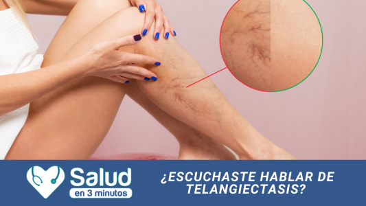 Telangiectasias: un problema varicoso muy común