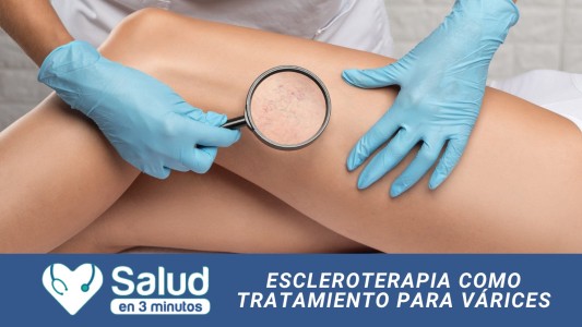Escleroterapia: el tratamiento efectivo para várices y arañitas