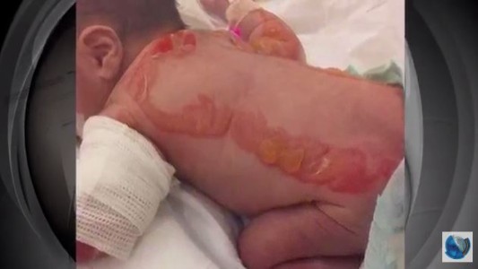 Mejora el bebé que sufrió quemaduras en la espalda y brazos en una clínica