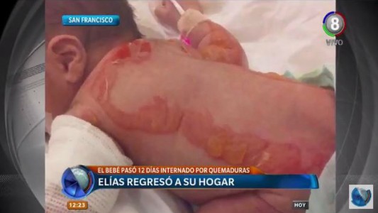 Elias volvió a su casa tras permanecer doce días internado por quemaduras