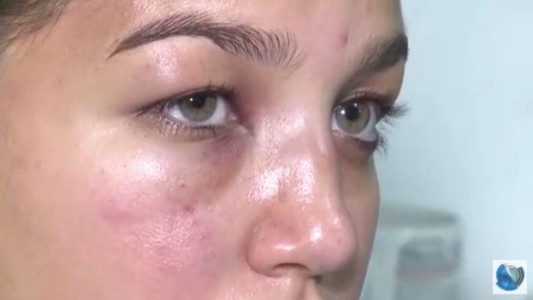 Joven denuncia golpiza en un boliche de la zona del Chateau