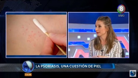 Psoriasis: Cómo tratarla y la importancia de un diagnóstico prematuro