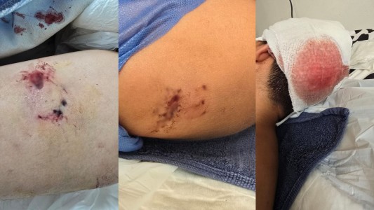 Un niño fue atacado por un pitbull en B° Los Boulevares y terminó hospitalizado