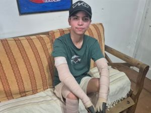 Un celular explotó y le provocó quemaduras en el 68% del cuerpo: el adolescente fue dado de alta tras dos meses internado